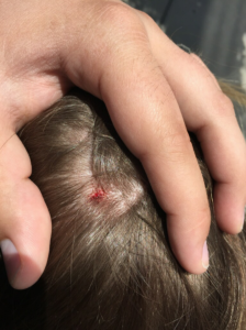 BYU student Brittny Lange was attacked by a hawk last week while walking between the Maeser and Brimhall buildings. The hawk scratched her head with its talons (Brittny Lange).